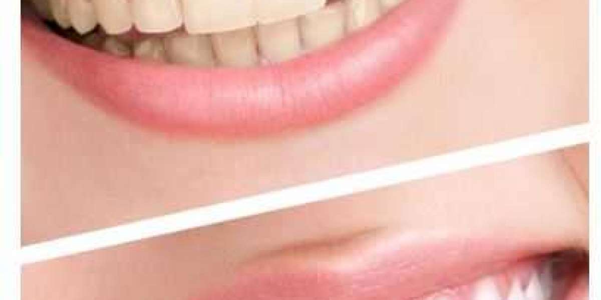 What Is the Most Effective Teeth Whitening Method?