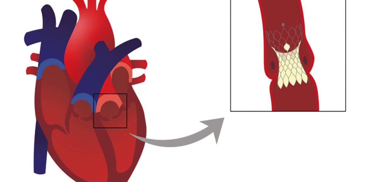 Percutaneous Aortic Valve Implantation Market Rising Trends and Growth Outlook by 2031 | Key playerBracco, Medtronic Plc