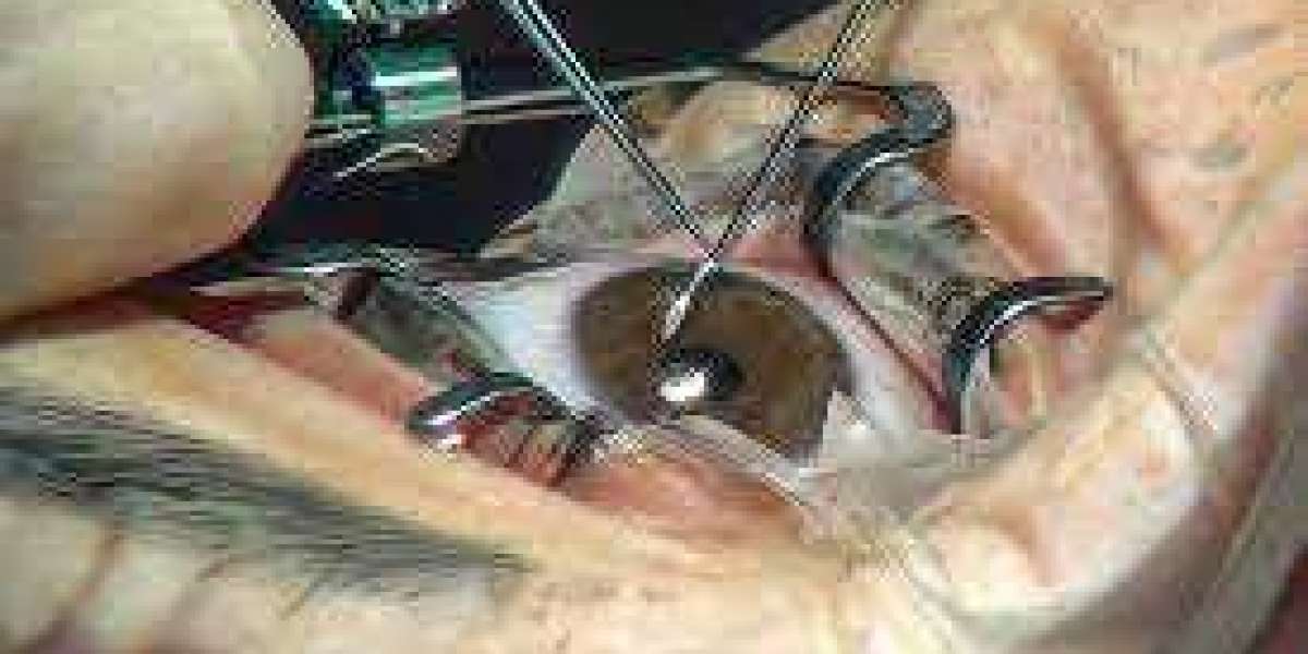 Micro-Invasive Glaucoma Surgery Devices Market projected to grow at a CAGR of over 34.45% during 2023 to 2030