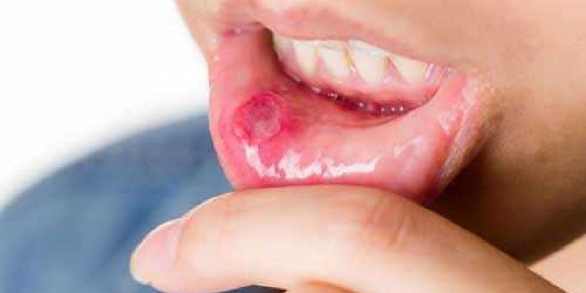 Mouth Ulcer Treatment Market Worth US$ 2.41 billion in 2027